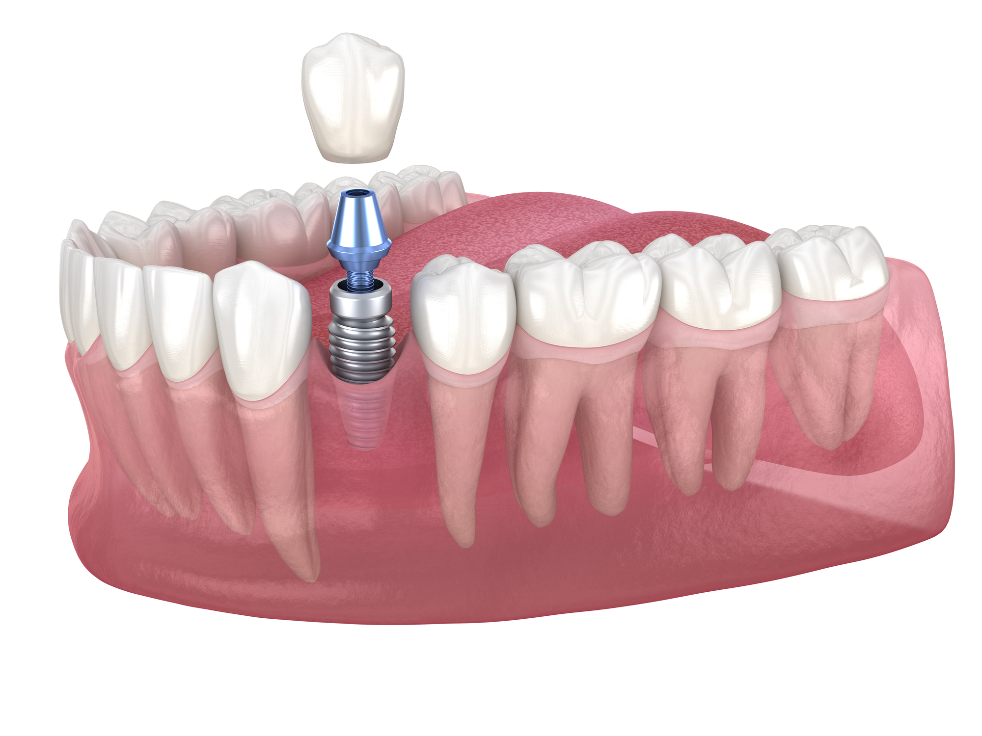 Premolar tooth recovery with implant. Medically accurate 3D illustration of human teeth and dentures concept